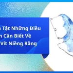 Tất Tần Tật Điều Bạn Cần Biết Về Cắm Vít Niềng Răng