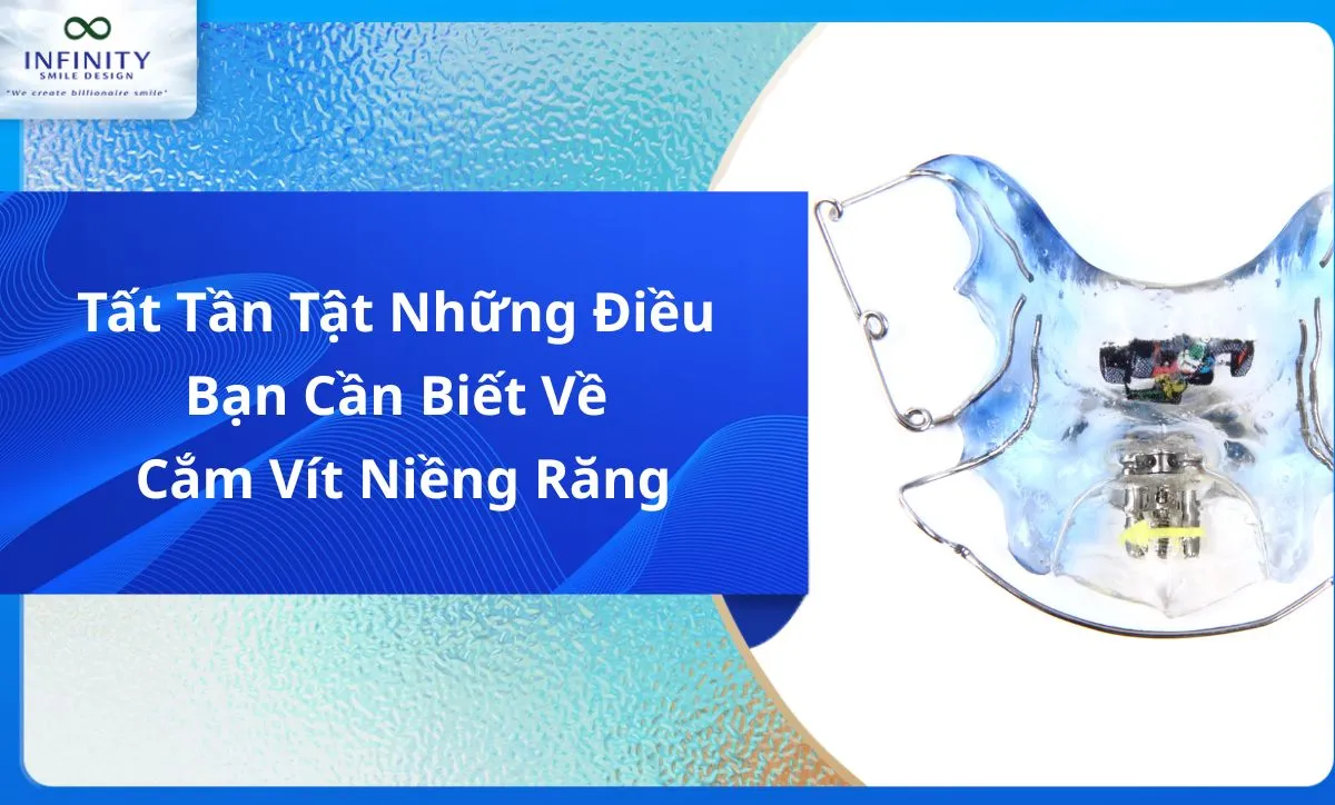 Tất Tần Tật Điều Bạn Cần Biết Về Cắm Vít Niềng Răng