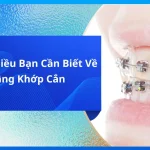 Những Điều Bạn Cần Biết Về Nâng Khớp Cắn