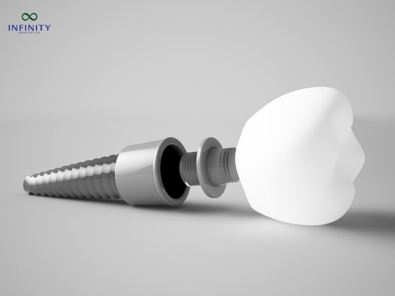 Lưu ý sau khi phục hình răng sứ trên Implant