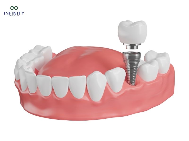 Tầm quan trọng của phục hình răng sứ trên Implant