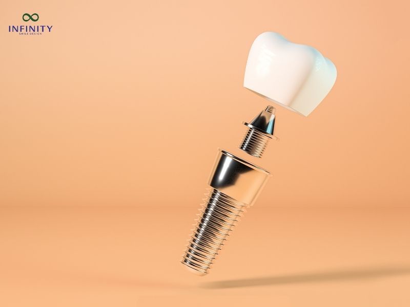 Quy trình phục hình răng sứ trên Implant