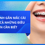 Quy trình gắn mắc cài: Tất cả những điều bạn cần biết