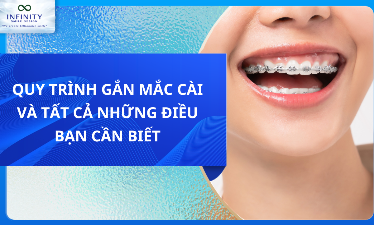 Quy trình gắn mắc cài: Tất cả những điều bạn cần biết