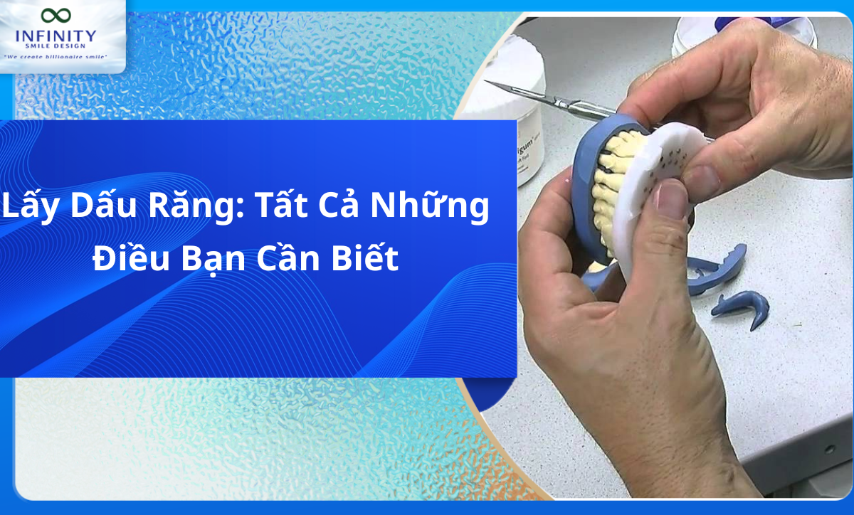 Lấy dấu răng: Tất cả những điều bạn cần biết