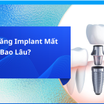 Trồng răng implant mất bao lâu?