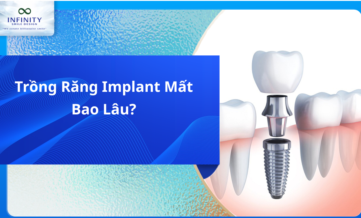 Trồng răng implant mất bao lâu?