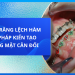 NIỀNG RĂNG LỆCH HÀM GIẢI PHÁP KIẾN TẠO GƯƠNG MẶT CÂN ĐỐI