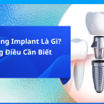 Trồng Răng Implant Là Gì?