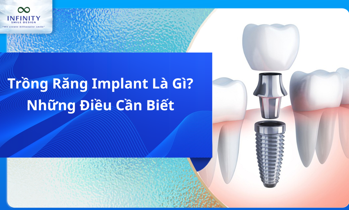Trồng Răng Implant Là Gì?