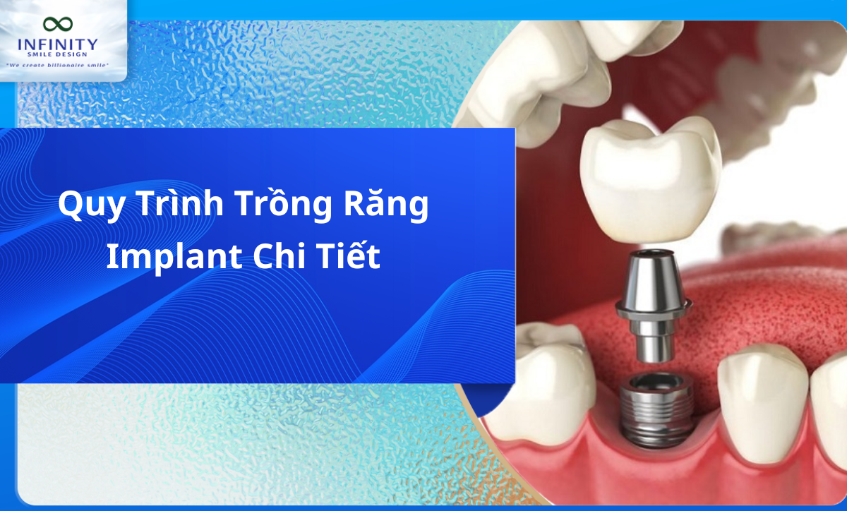 Quy trình trồng răng implant chi tiết