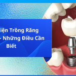 Điều kiện trồng răng implant