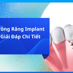 Có Nên Trồng Răng Implant Không? Giải Đáp Chi Tiết