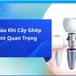 Lưu ý sau khi cấy ghép Implant