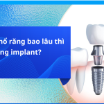 Sau khi nhổ răng bao lâu thì có thể trồng răng implant