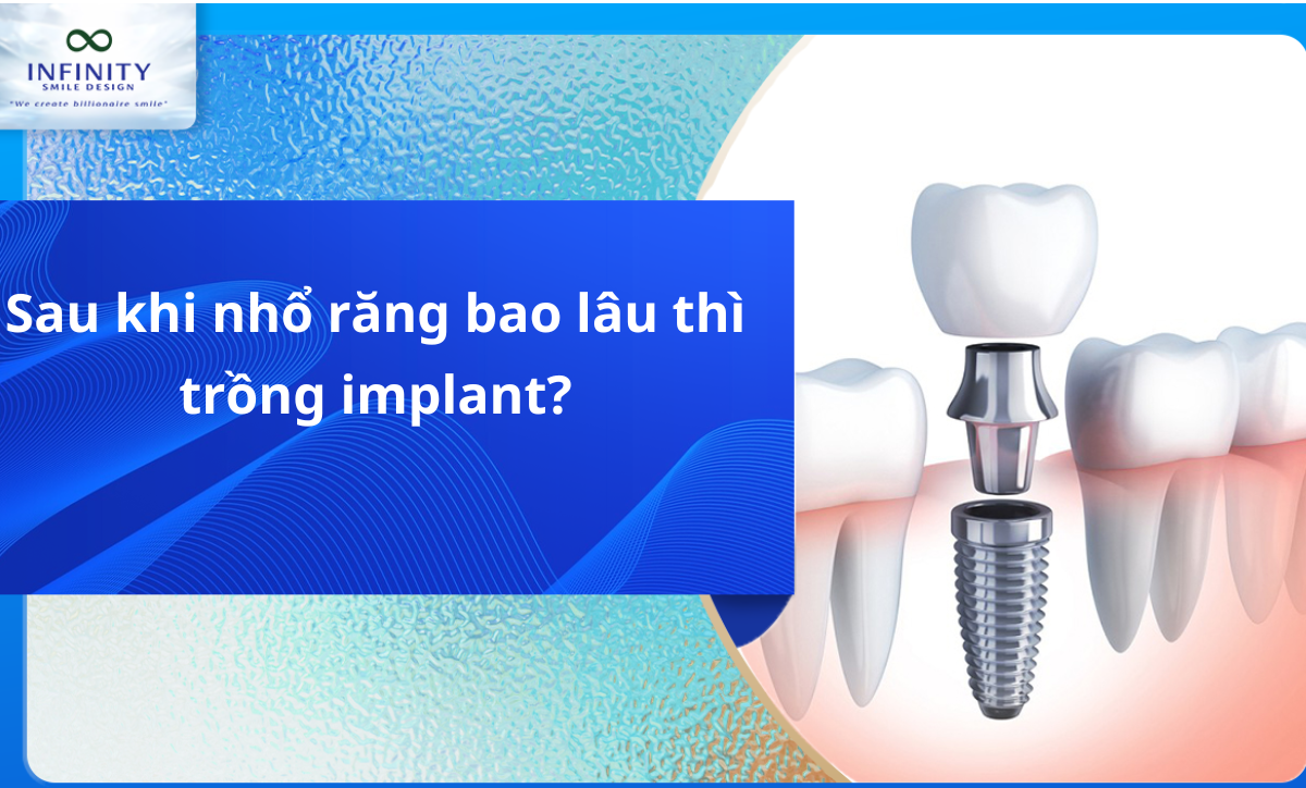 Sau khi nhổ răng bao lâu thì có thể trồng răng implant