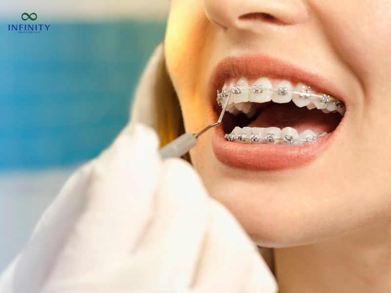 Các loại niềng răng mắc cài tự buộc phổ biến