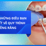 TẤT CẢ NHỮNG ĐIỀU BẠN CẦN BIẾT VỀ QUY TRÌNH NIỀNG RĂNG
