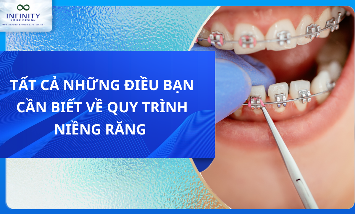 TẤT CẢ NHỮNG ĐIỀU BẠN CẦN BIẾT VỀ QUY TRÌNH NIỀNG RĂNG