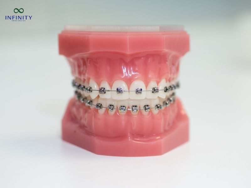 Hiểu rõ về răng giả và cơ chế niềng răng