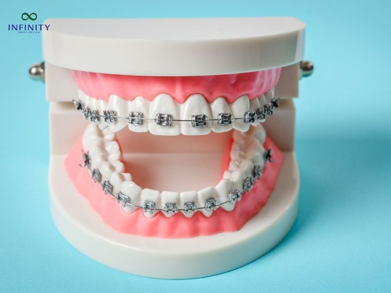 Răng giả có niềng được không?
