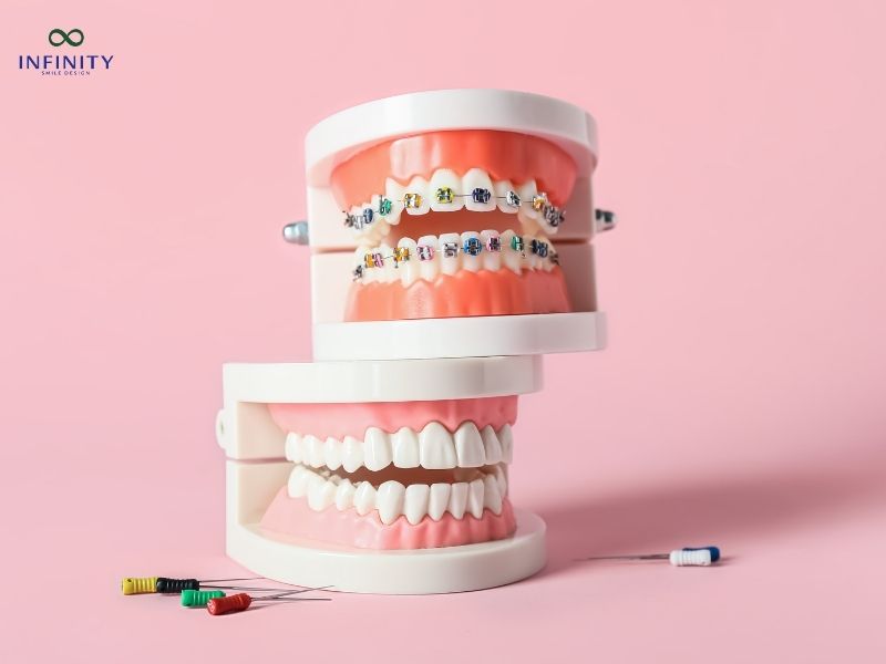 Răng giả có niềng được không?