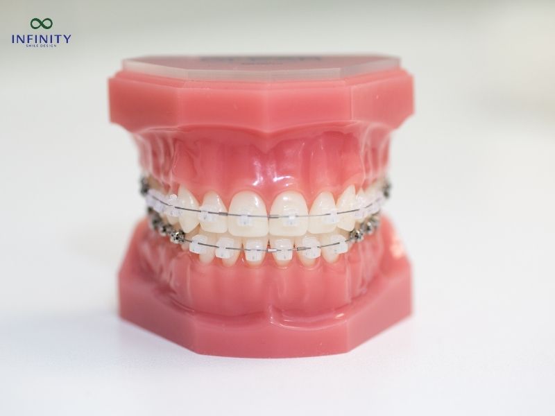 Các biến chứng và rủi ro tiềm ẩn nếu niềng răng giả không đúng cách