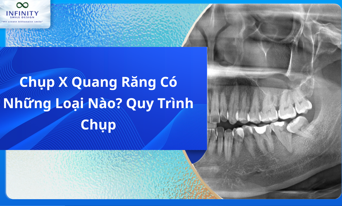 Chụp X Quang Răng Có Những Loại Nào? Quy Trình Chụp
