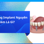 Trồng răng implant nguyên hàm