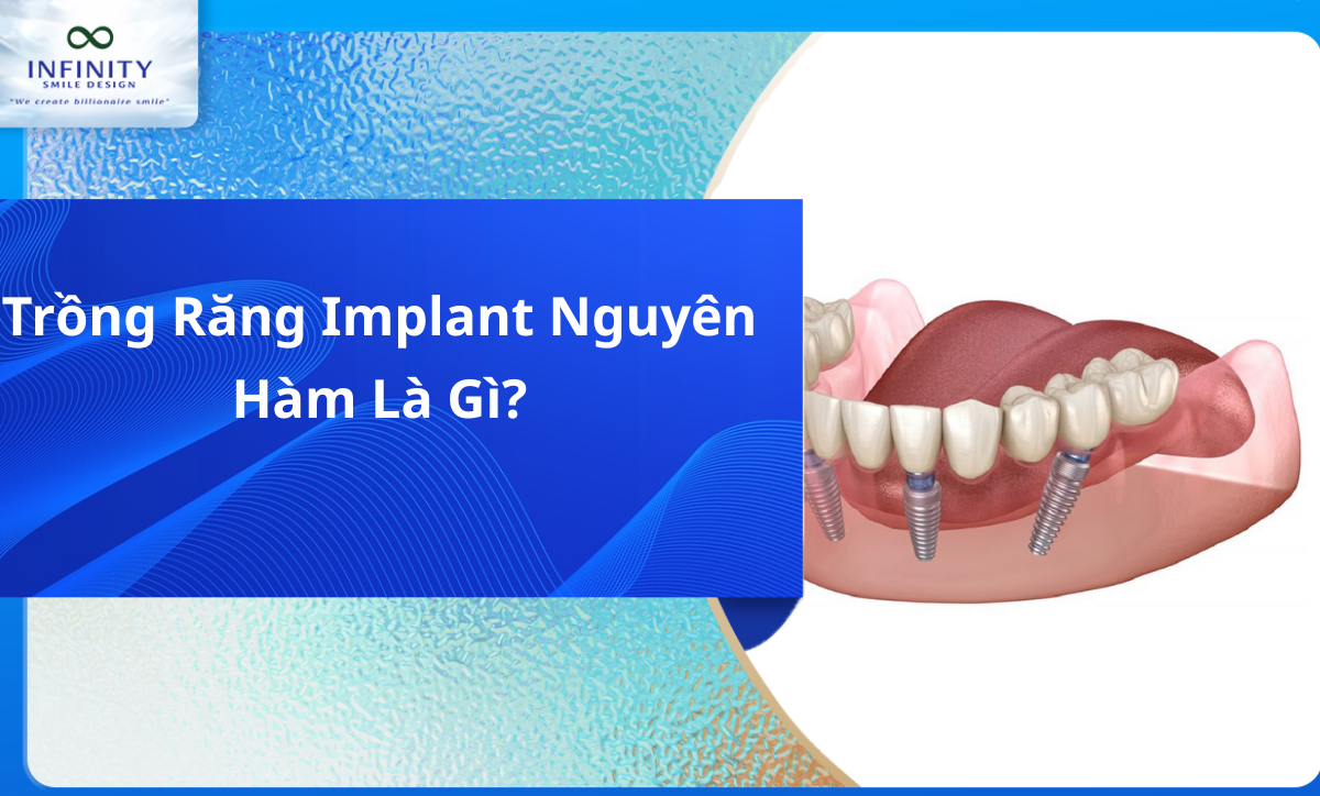 Trồng răng implant nguyên hàm