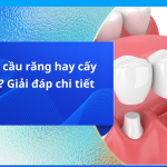Nên làm cầu răng hay cấy implant?