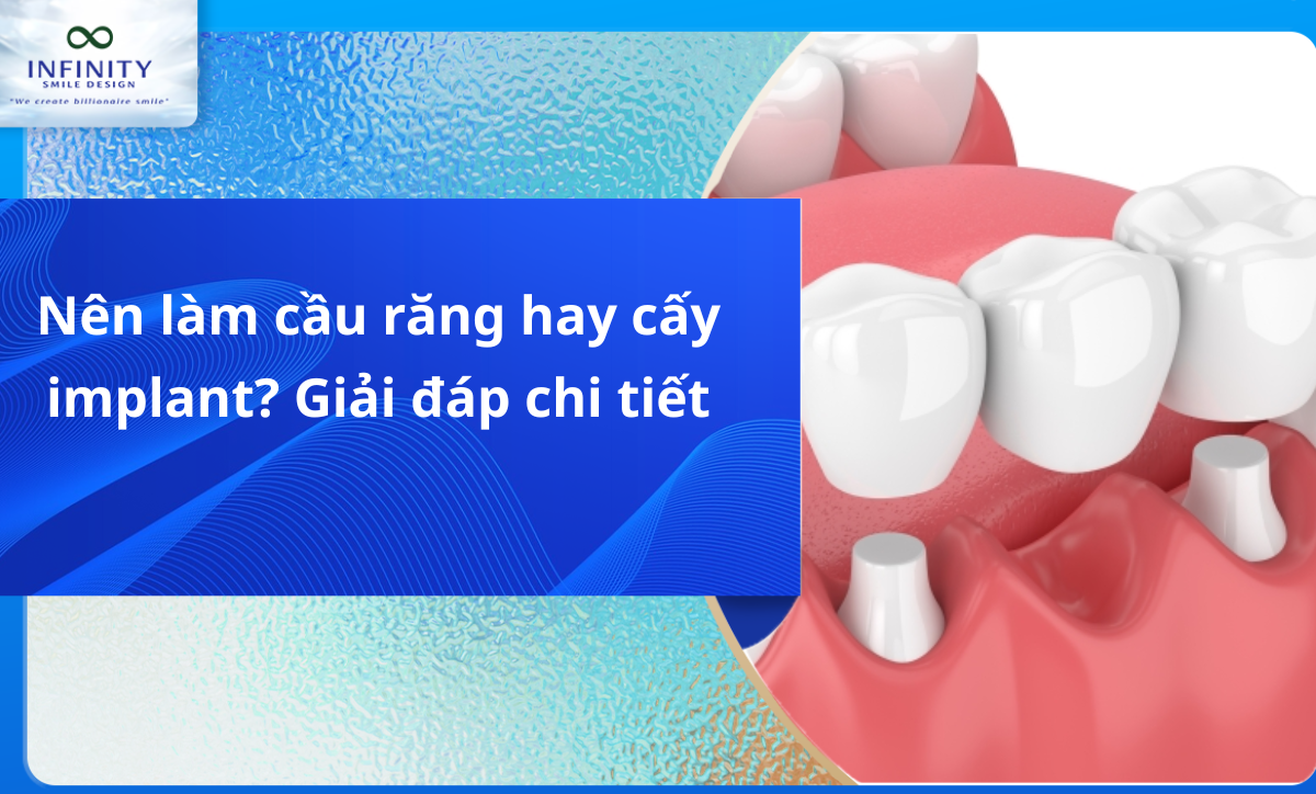 Nên làm cầu răng hay cấy implant?