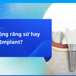 Nên trồng răng sứ hay Implant?