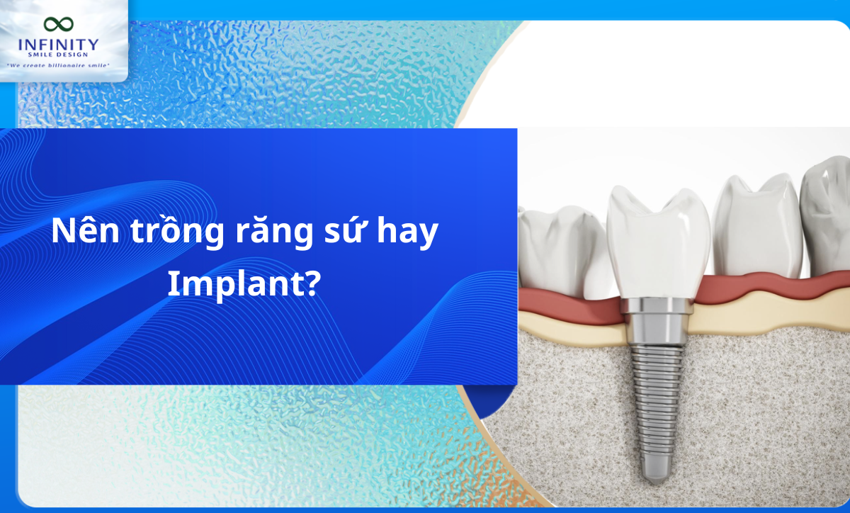 Nên trồng răng sứ hay Implant?