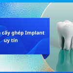 Nha khoa cấy ghép implant uy tín