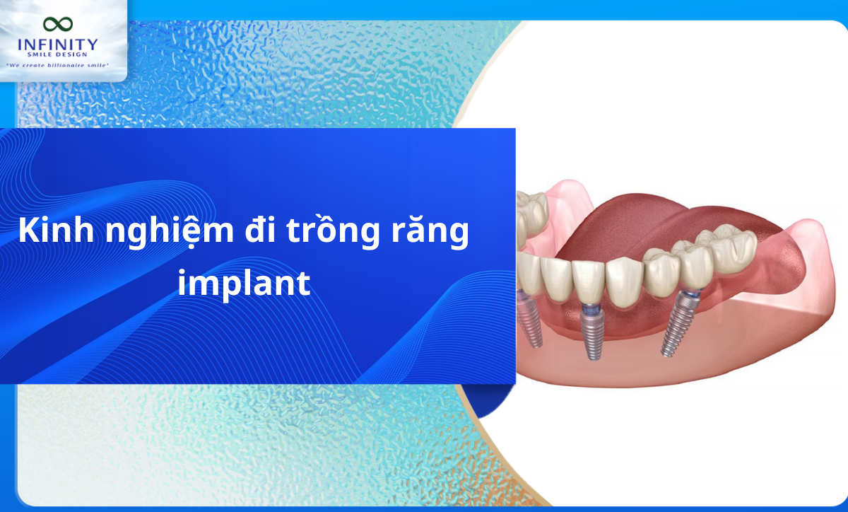 Review thực tế 7 kinh nghiệm đi trồng răng Implant