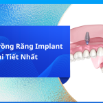 REVIEW TRỒNG RĂNG IMPLANT NGUYÊN HÀM