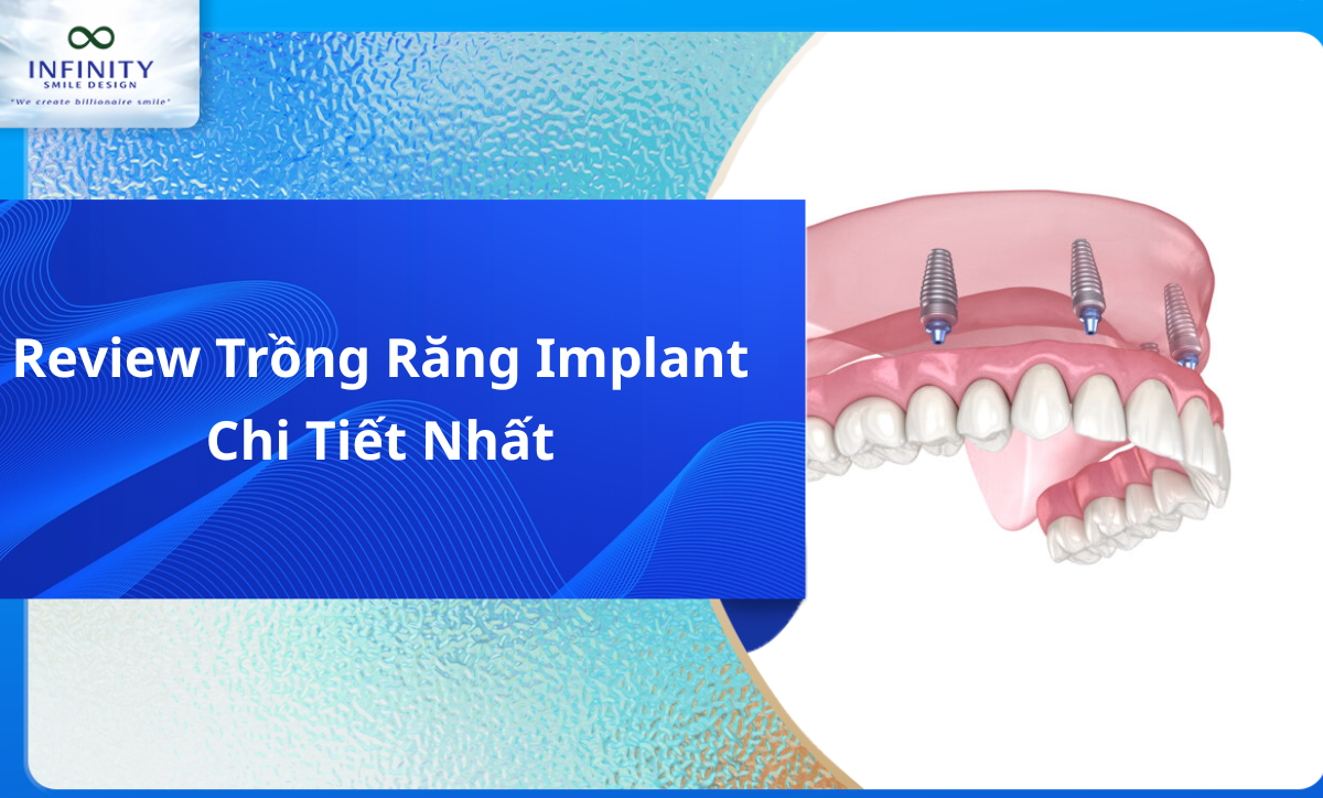 REVIEW TRỒNG RĂNG IMPLANT NGUYÊN HÀM