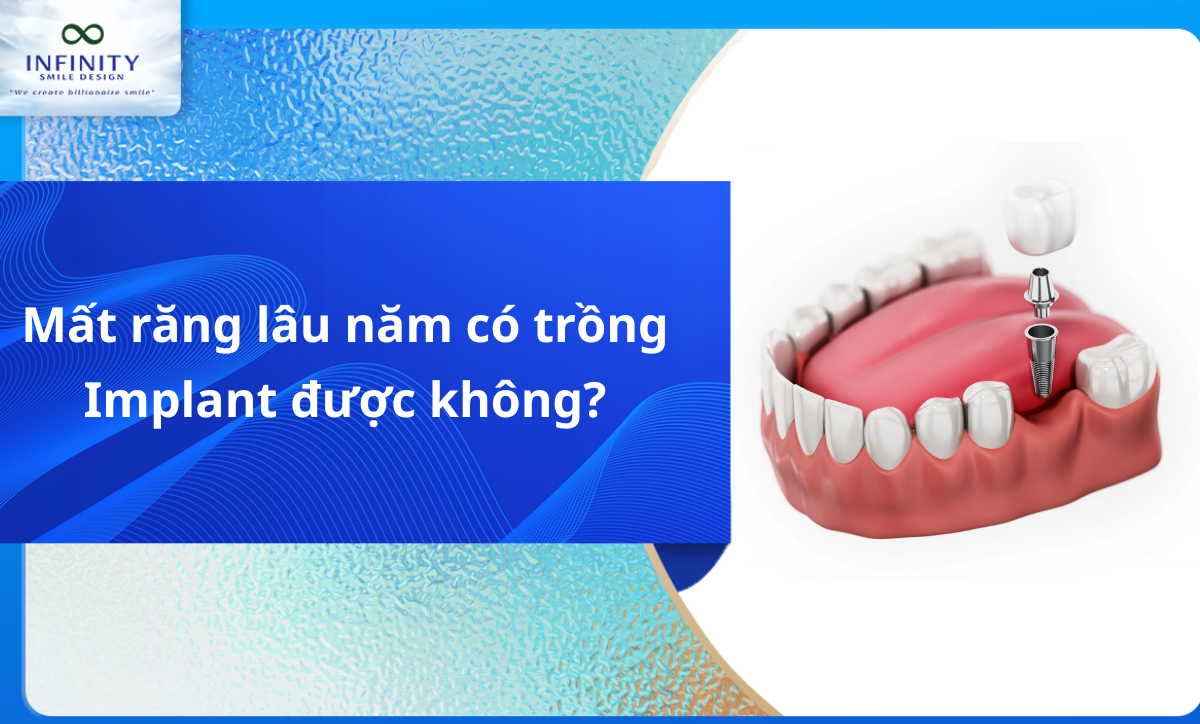 Mất răng lâu năm có trồng implant được không?