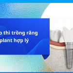 Khi nào thì trồng răng implant? Tìm hiểu chi tiết