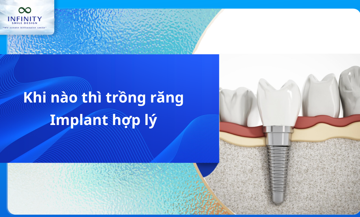 Khi nào thì trồng răng implant? Tìm hiểu chi tiết