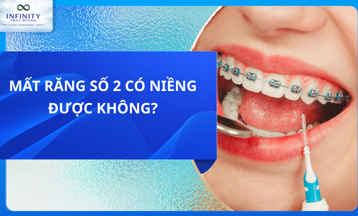 MẤT RĂNG SỐ 2 CÓ NIỀNG ĐƯỢC KHÔNG