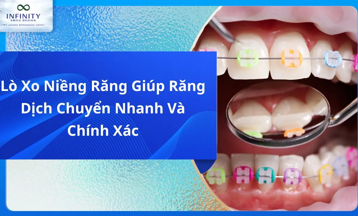 Lò Xo Niềng Răng Giúp Răng Dịch Chuyển Nhanh Và Chính Xác