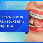 Đeo Thun Tách Kẽ Và Bí Quyết Chăm Sóc Kẽ Răng Hiệu Quả