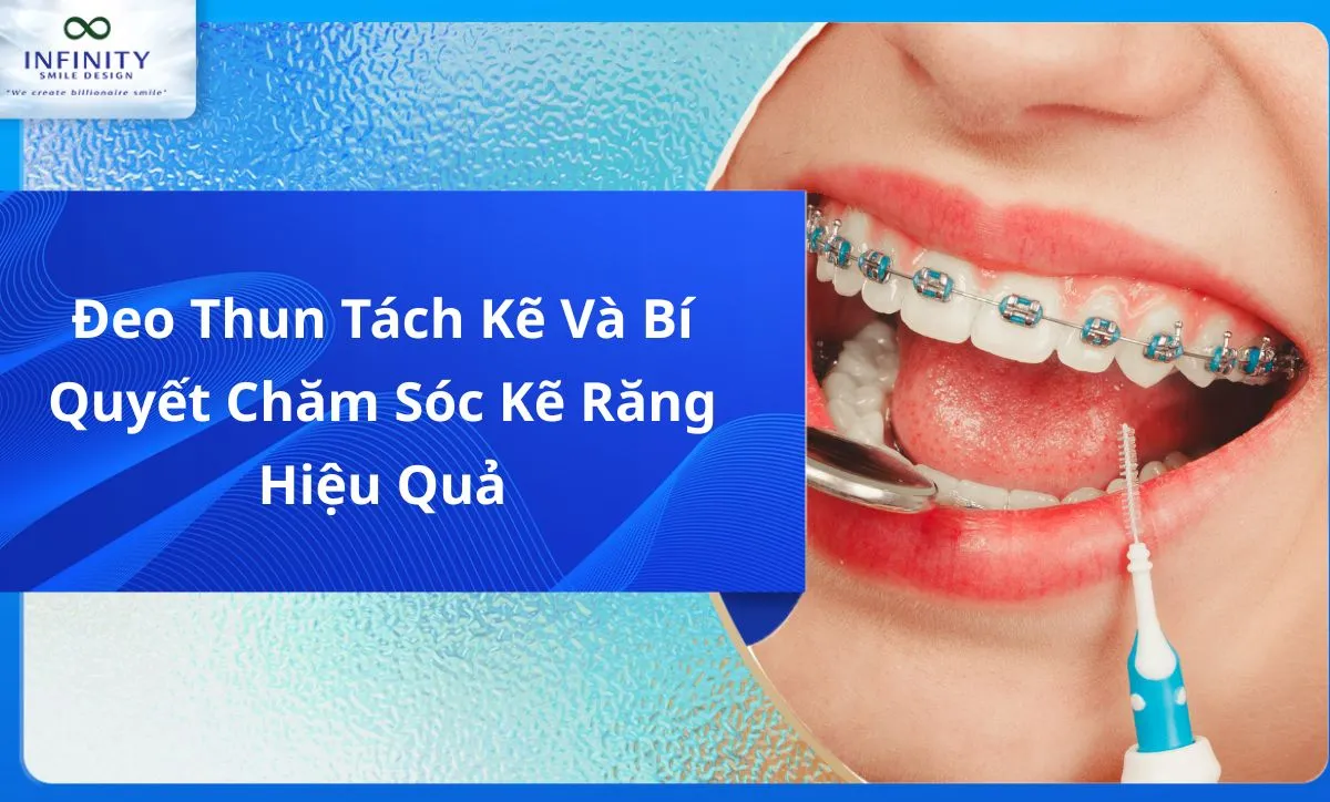 Đeo Thun Tách Kẽ Và Bí Quyết Chăm Sóc Kẽ Răng Hiệu Quả