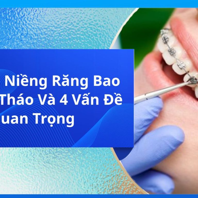 Cắm Vít Niềng Răng Bao Lâu Thì Tháo Và 4 Vấn Đề Quan Trọng
