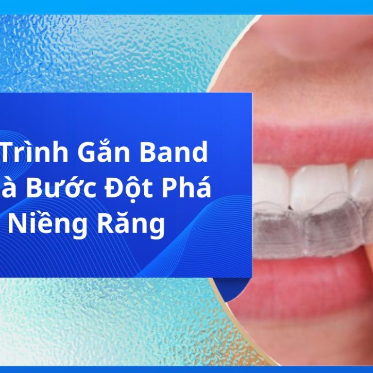 5 Quy Trình Gắn Band Răng Là Bước Đột Phá Khi Niềng Răng