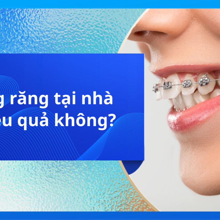 Niềng răng tại nhà có hiệu quả không?