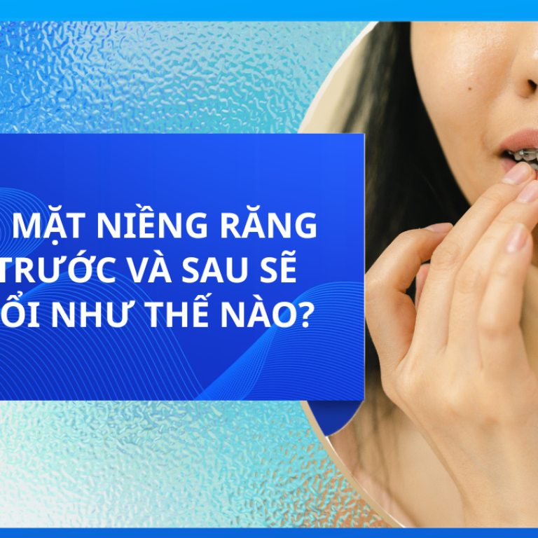 KHUÔN MẶT NIỀNG RĂNG MÓM TRƯỚC VÀ SAU SẼ THAY ĐỔI NHƯ THẾ NÀO?