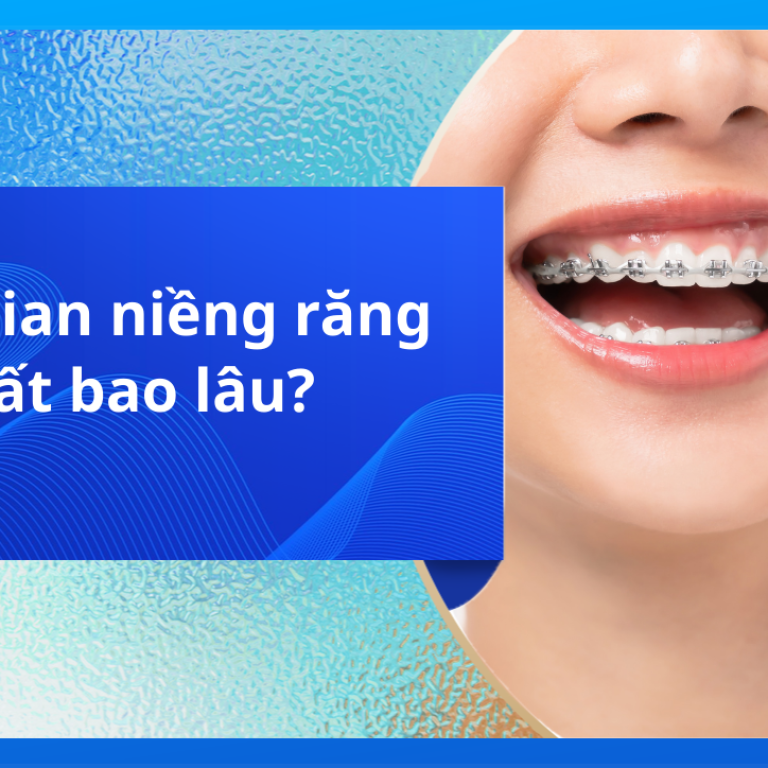 Thời gian niềng răng mất bao lâu?